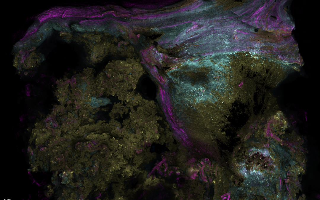 January 2, 2025 | UCLA study links scar healing to dangerous placenta condition